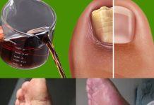 Get rid of nail fungus naturally: have healthy and shiny nails using vinegar.