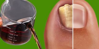 Get rid of nail fungus naturally: have healthy and shiny nails using vinegar.