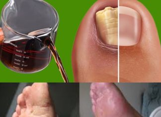 Get rid of nail fungus naturally: have healthy and shiny nails using vinegar.