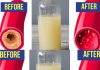 Only a Glass of This Juice Will Remove Clogged Arteries and Control Blood Pressure – Garlic, Lemon, and Apple Cider Vinegar