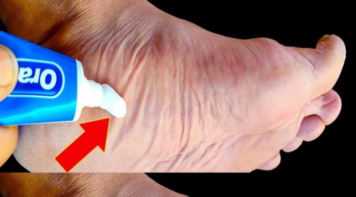 Stop Spending Money at the Pharmacy! Put Toothpaste on Your Feet (Did You Know That?)
