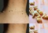 How to Easily Remove Skin Tags with Garlic
