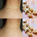 How to Easily Remove Skin Tags with Garlic