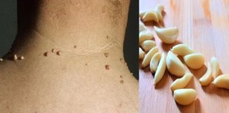 How to Easily Remove Skin Tags with Garlic