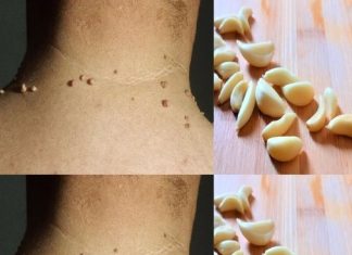 How to Easily Remove Skin Tags with Garlic
