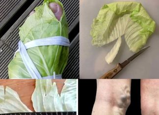 Amazing Remedy for Varicose Veins: Cabbage Leaves