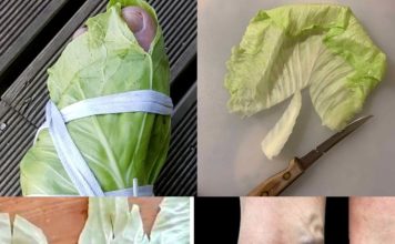 Amazing Remedy for Varicose Veins: Cabbage Leaves