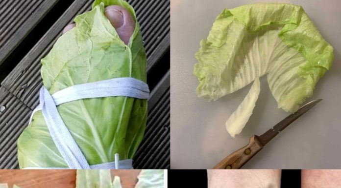 Amazing Remedy for Varicose Veins: Cabbage Leaves