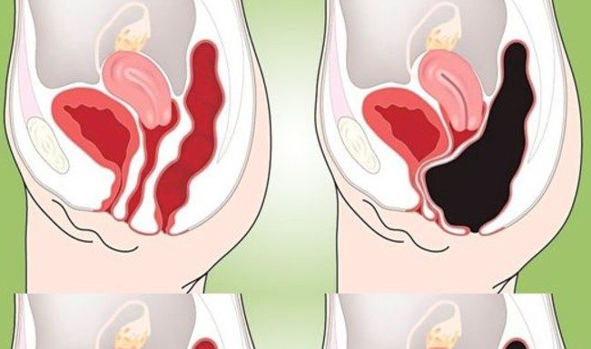 How to Cleanse Your Colon Naturally at Home