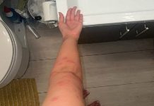 I have no idea what these are does anyone know what ive been bitten by please ? I have two on the other side aswell