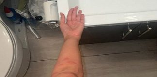 I have no idea what these are does anyone know what ive been bitten by please ? I have two on the other side aswell