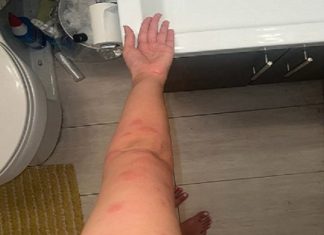 I have no idea what these are does anyone know what ive been bitten by please ? I have two on the other side aswell