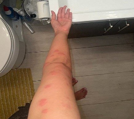 I have no idea what these are does anyone know what ive been bitten by please ? I have two on the other side aswell