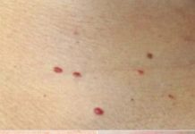 Red dots on your skin: Causes and what they could mean