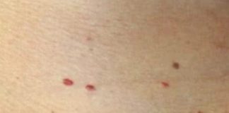 Red dots on your skin: Causes and what they could mean