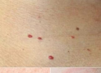 Red dots on your skin: Causes and what they could mean