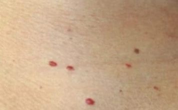 Red dots on your skin: Causes and what they could mean