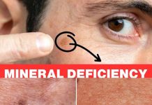 Your Age Spots Are Caused by a Deficit in Selenium: Why You Need It