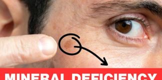 Your Age Spots Are Caused by a Deficit in Selenium: Why You Need It