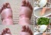 Home Remedies for Swollen Feet