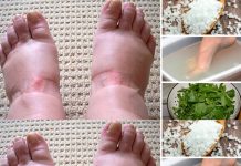 Home Remedies for Swollen Feet