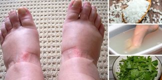 Home Remedies for Swollen Feet