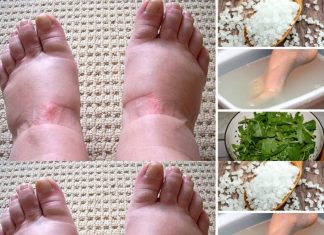 Home Remedies for Swollen Feet