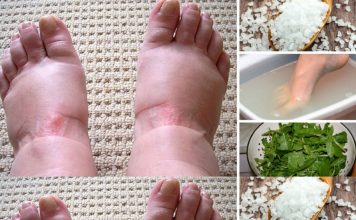 Home Remedies for Swollen Feet