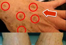 The BEST Vitamin to Remove Age Spots