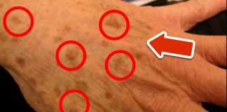 The BEST Vitamin to Remove Age Spots