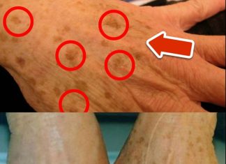 The BEST Vitamin to Remove Age Spots