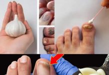This Is a Nail Fungus Killer (It Works Very Fast)