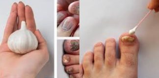 This Is a Nail Fungus Killer (It Works Very Fast)