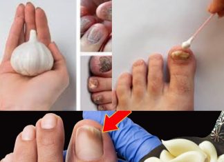 This Is a Nail Fungus Killer (It Works Very Fast)