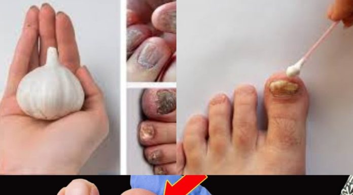 This Is a Nail Fungus Killer (It Works Very Fast)