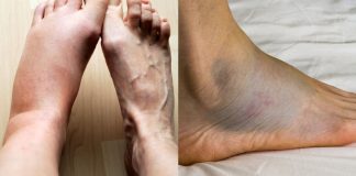 This Vitamin Removes Swelling in the Feet and Legs