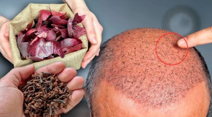 The Surprising Hair Growth Benefits of Cloves and Onion Peels
