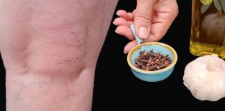 Leg Pain, Rheumatism, Varicose Veins, Arthritis – Natural Remedy with Cloves & Garlic! 🧄🌿