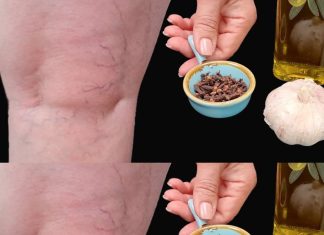 Leg Pain, Rheumatism, Varicose Veins, Arthritis – Natural Remedy with Cloves & Garlic! 🧄🌿