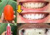Say Goodbye to Yellow Teeth with This Natural Recipe! Get Whiter Teeth in Just Minutes Without Spending Money at the Dentist