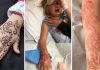 Little Girl Suffered Severe Chemical Burns Caused by a Temporary Tattoo