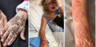 Little Girl Suffered Severe Chemical Burns Caused by a Temporary Tattoo