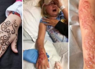 Little Girl Suffered Severe Chemical Burns Caused by a Temporary Tattoo