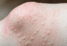 Got these raised bumps near my knees. Doctor’s appt is far away. What should I do? What is it?