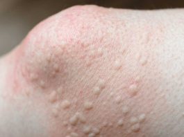 Got these raised bumps near my knees. Doctor’s appt is far away. What should I do? What is it?