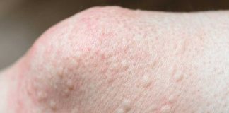 Got these raised bumps near my knees. Doctor’s appt is far away. What should I do? What is it?