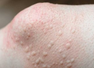 Got these raised bumps near my knees. Doctor’s appt is far away. What should I do? What is it?