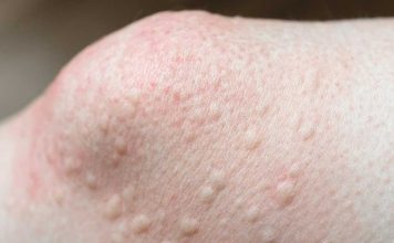 Got these raised bumps near my knees. Doctor’s appt is far away. What should I do? What is it?