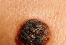 This mole keeps crusting over and peeling off again, and my appointment is weeks away. Should I be worried?