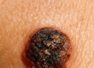 This mole keeps crusting over and peeling off again, and my appointment is weeks away. Should I be worried?